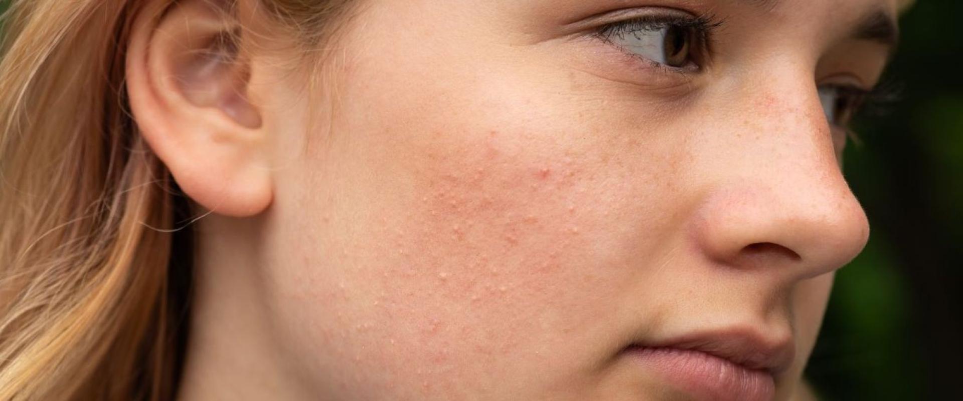 Trądzik różowaty – jak dbać o skórę jesienią i zimą? Skuteczne metody na złagodzenie objawów