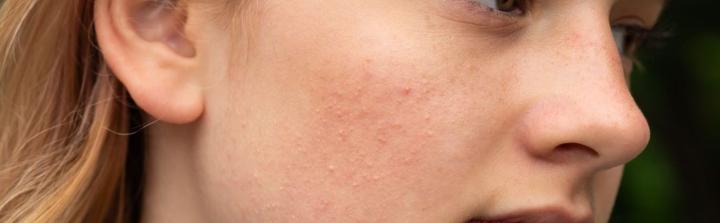 Trądzik różowaty – jak dbać o skórę jesienią i zimą? Skuteczne metody na złagodzenie objawów